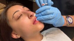Can Lip Fillers Adjust Uneven Lip Shape Effectively?