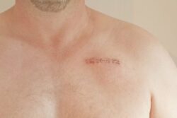 Can the Best Scar Removal Help With Old Scar Marks?
