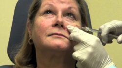 Can Under-Eye Filler Treatment Improve Eye Contour Shape