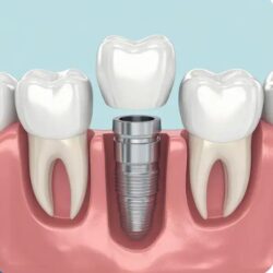 Root Canal Treatment Penrith
