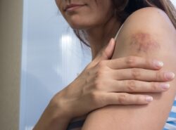 Do Keloid Treatments Really Stop Scar Growth?