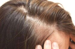 Hair Loss Treatment for Aging Hair: What Works Best?