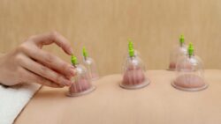 Hijama Cupping Therapy for Tension Headaches
