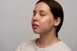 How Can Pimples Be Cleared Without Skin Damage?
