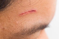 How Can the Best Scar Removal Support Smoother Skin?