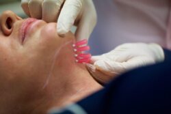 How do PDO Mono Threads improve facial skin firmness?