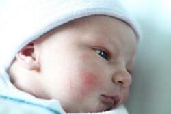 How Does Birthmarks Removal Target Vascular Birthmarks