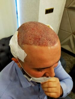 How Does Hair Transplant Transform Hair Restoration Results?