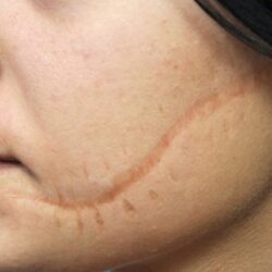 How Does Scar Removal Work for Deep and Surface Scars?