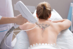 How Effective Is Laser Tattoo Removal on Mixed Ink Colors?