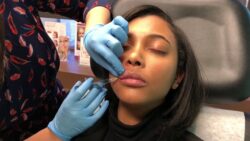 How Effective Is Lip Flip For Upper Lip Shaping Results?