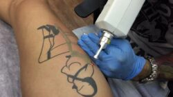 How Fast Can Laser Tattoo Removal Fade Your Tattoo?