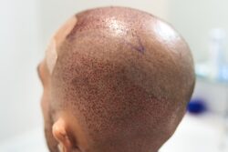 Is Hair Transplant the Best Treatment for Hair Loss