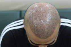 Is Hair Transplant the Best Treatment for Hair Loss