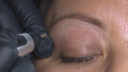 Is Plasma Pen Treatment Safe for All Skin Types