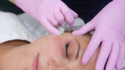 Is Vampire Facial Recommended for Oily Skin Types?