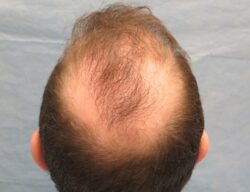 What Areas Can Crown Hair Transplant Target Effectively?