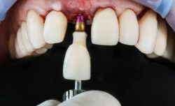 What Is Average Single Tooth Implant Cost in Dubai?