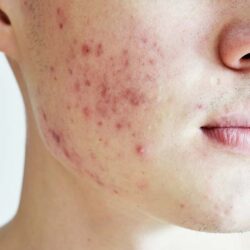 What Makes Pimples Treatment Effective for Recurring Acne Issues?