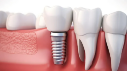 Why Consider Single Tooth Implant Cost in Dubai Before Surgery?