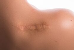 Why Do Keloids Form After Minor Skin Injuries?