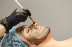 Will Laser Carbon Peel Reduce Post-Acne Redness Without Irritation?