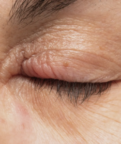 Eyelid Xanthelasma Removal: Understanding the Root Cause
