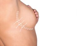 What Kind of Anesthesia Is Used in a Breast Lift?