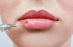 Can Belotero fillers restore youthful lip appearance?