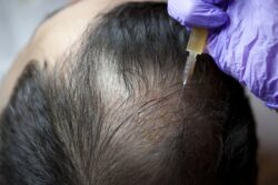 Can G Cell Hair Treatment Prevent Further Hair Loss?