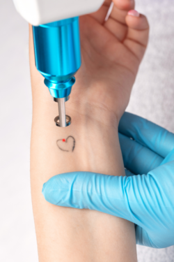 Can Laser Tattoo Removal Lighten Long-Standing Tattoos?