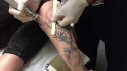 Can Laser Tattoo Removal Work on Old Tattoos Effectively?