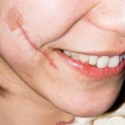 Can Scar Removal Improve Skin Texture Over Time?