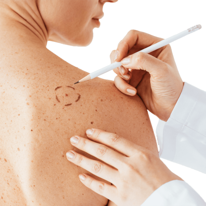Can Skin Tag Removal Improve Comfort From Skin Lumps and Tags?