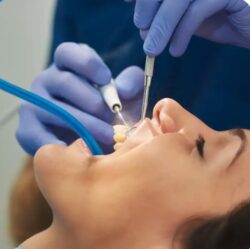 Teeth Cleaning Penrith
