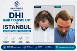 DHI Hair Transplant in Istanbul: The Modern Solution for Hair Loss