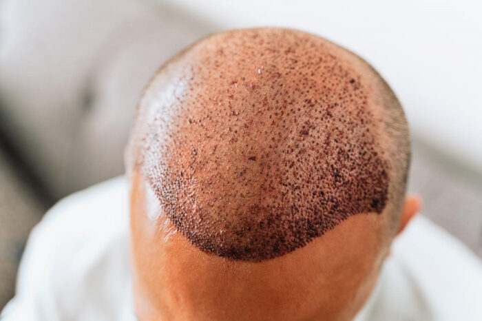 Does Hair Transplant Make Hair Look Thicker Naturally?