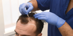 Does Hair Transplant Stop Future Hair Loss?