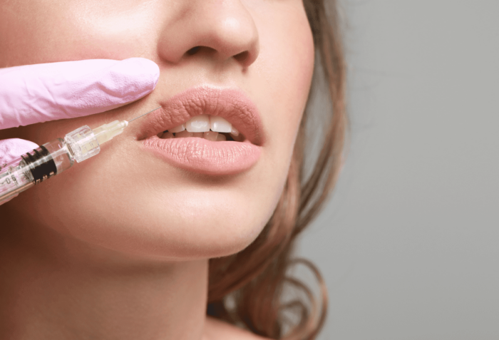 How Do Lip Fillers Enhance Lip Color and Appearance?