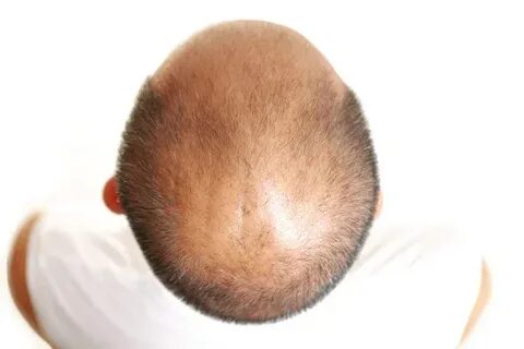How does crown hair transplant improve hair growth?