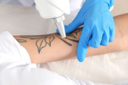 How does laser tattoo removal actually work on skin?