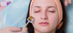 How Does Microneedling Help Reduce Visible Acne Scars?