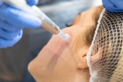 How Does Microneedling Improve Skin Texture Naturally?