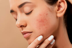 How Does the Best Acne Treatment Target Root Causes of Acne?