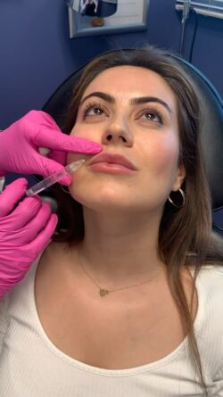 How Long Do Lip Lift Results Last on Lips and Facial Aging?
