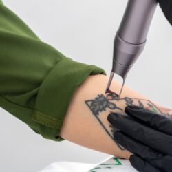 Is Laser Tattoo Removal Safe for All Skin Types?