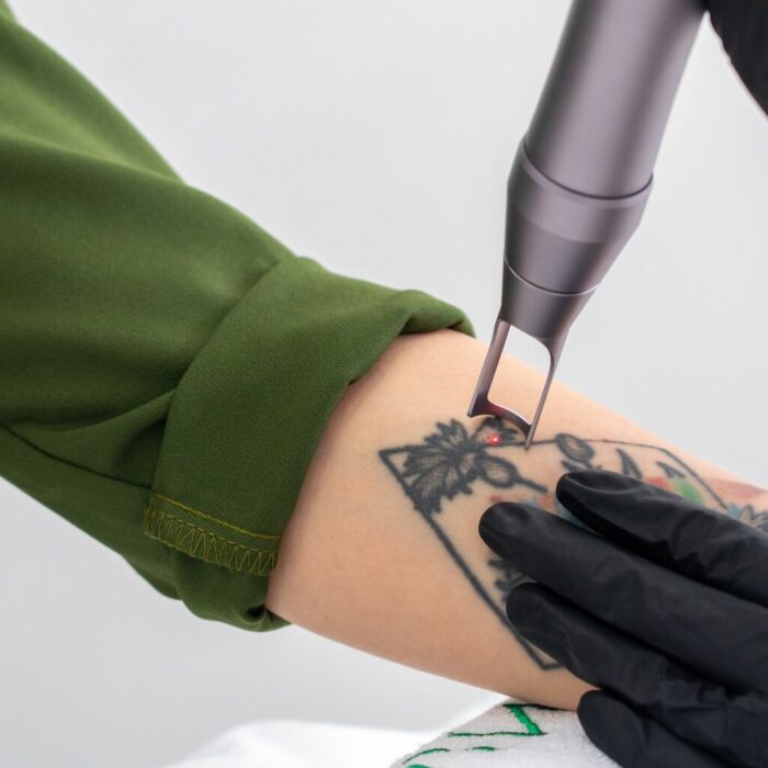 Is Laser Tattoo Removal Safe for All Skin Types?
