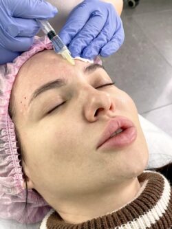 What Makes the Best Forehead Botox Look Natural?