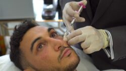 What Results Can You Expect From Under-Eye Filler Treatment?