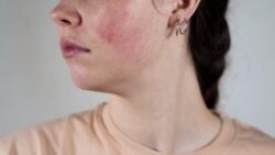 What Skin Concern Can Facial Capillaries Treatment Treat?